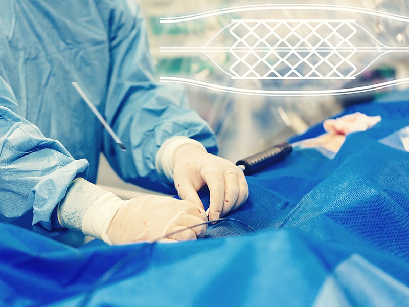 آنژیوپلاستی-