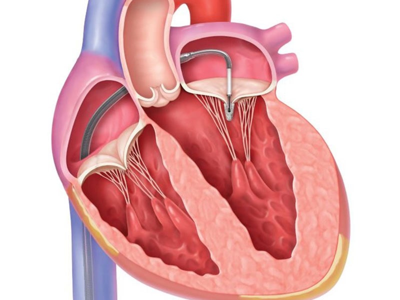 نارسایی-دریچه-میترال-