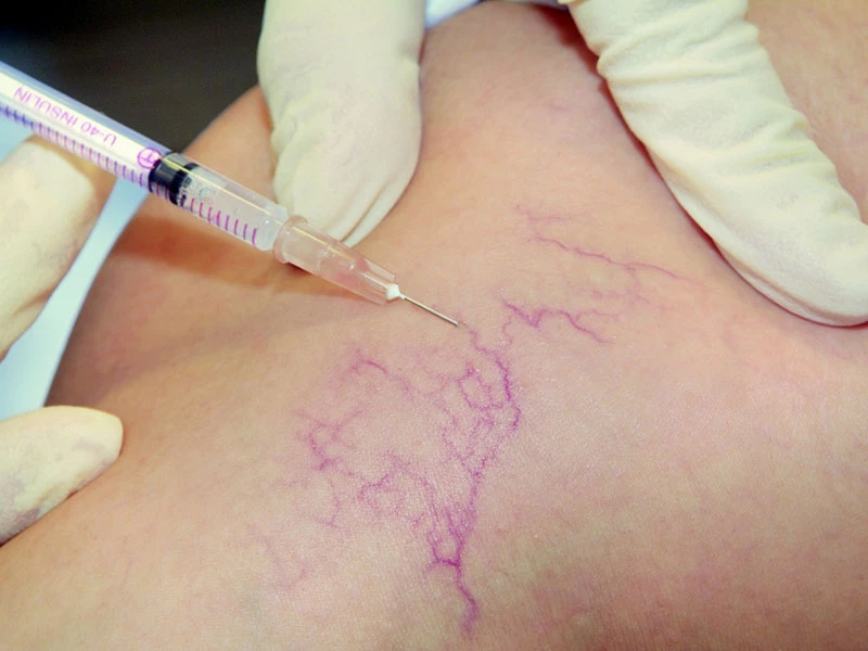 میکرو-اسکلروتراپی-برای-درمان-واریس