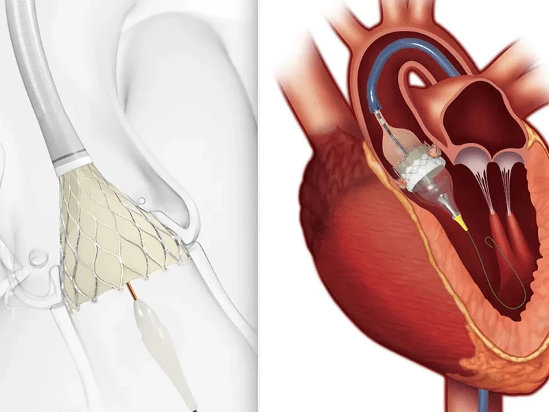 تنگی-دریچه-آئورت-