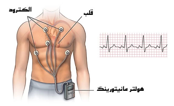 عملکرد-دستگاه-هولتر-