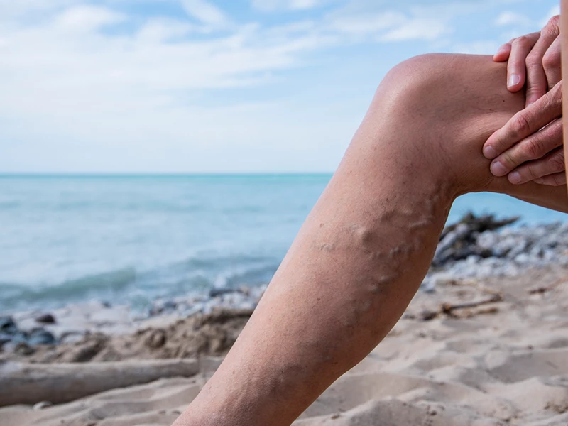 جلوگیری-از-پیشرفت-واریس