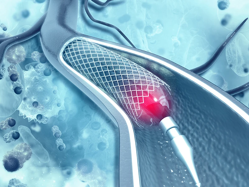 هزینه آنژیوپلاستی