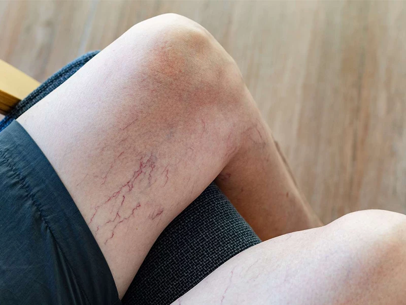 درمان عروق عنکبوتی