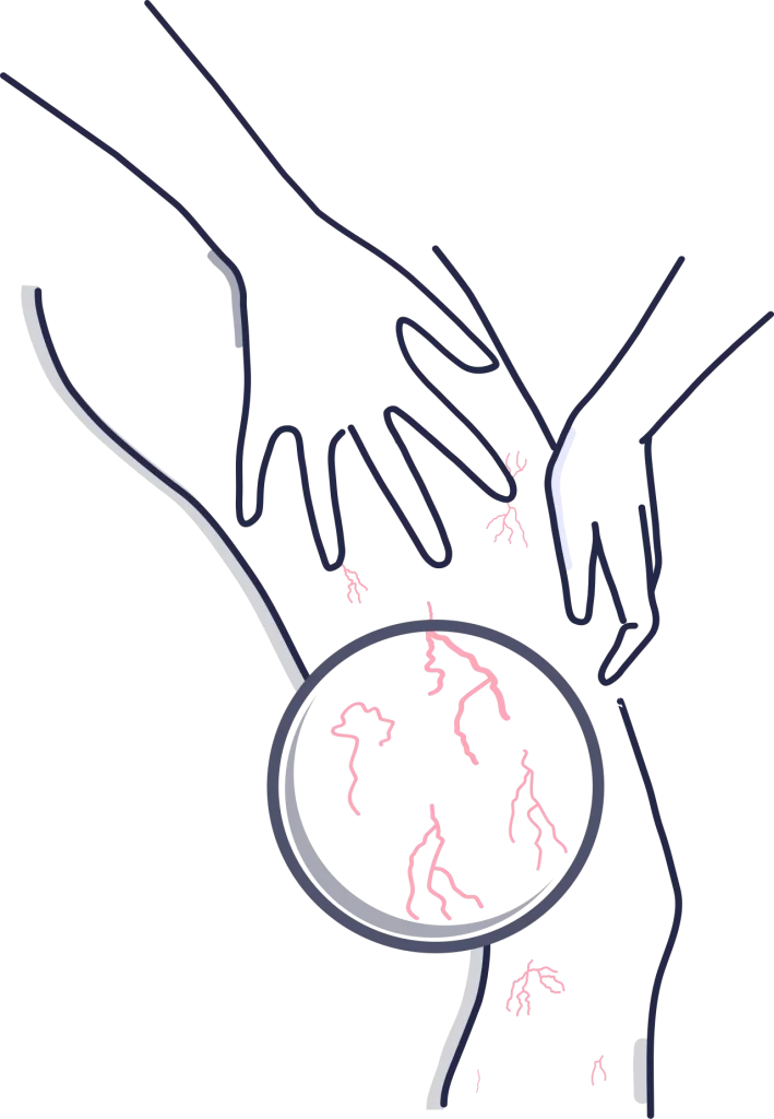 عروق-واریسی-پا